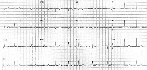 Bidirectional ventricular tachycardia due to digoxin-diuretic interaction in post-cardiac surgery patient: a case report.