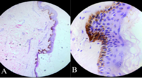 Linear Atrophoderma of Moulin: A Case Report.