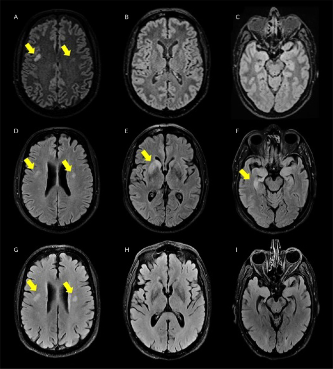 Anti-LGI1 Autoimmune Encephalitis in a Patient with Rheumatoid Arthritis and MGUS.