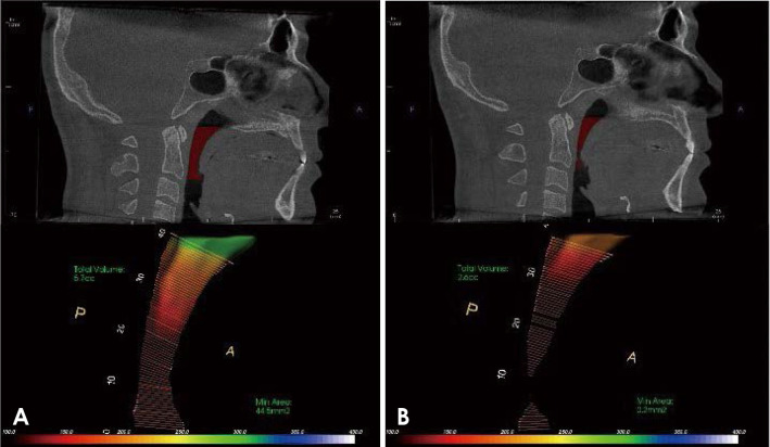 Correlation between cone-beam computed tomographic findings and the apnea-hypopnea index in obstructive sleep apnea patients: A cross-sectional study.