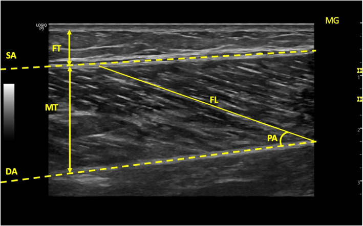Differences in ankle and knee muscle architecture and plantar pressure distribution among women with knee osteoarthritis.