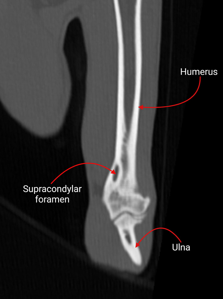 An arch worth revisiting: a study on the feline humeral supracondylar foramen and its evolutionary significance.