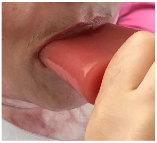 Optimising Scar Management Intervention in the Case of a Head-and-Neck Burn for a Patient with a Learning Disability.