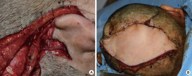 Use of the frontal branch of the superficial temporal artery and the postauricular vein to overcome anatomic variations of superficial temporal vessels in scalp reconstruction with free tissue transfer: a case report.