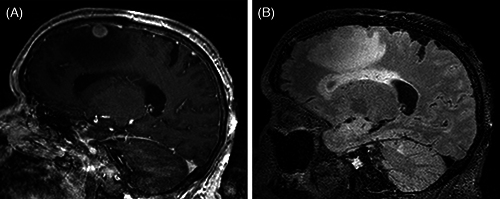 Extracavitary primary effusion lymphoma presenting as a solitary brain mass.