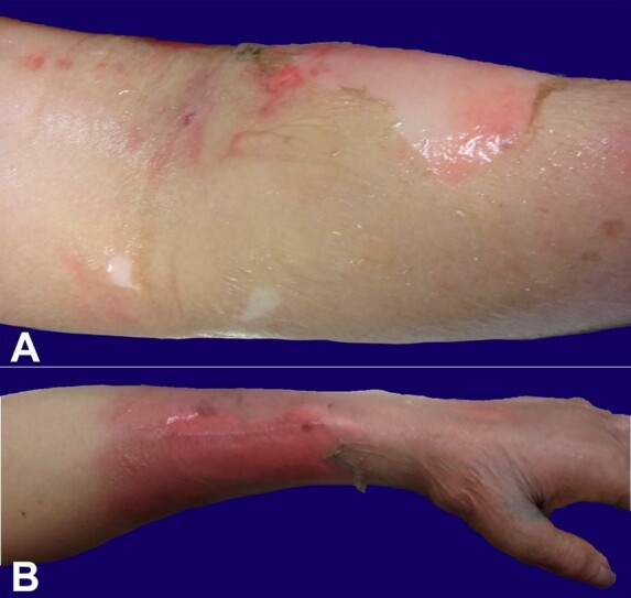 Emerging infection: streptococcal toxic shock-like syndrome caused by group B Streptococcus (GBS), <i>Streptococcus agalactiae</i>.