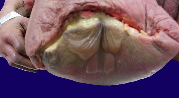 Emerging infection: streptococcal toxic shock-like syndrome caused by group B Streptococcus (GBS), <i>Streptococcus agalactiae</i>.
