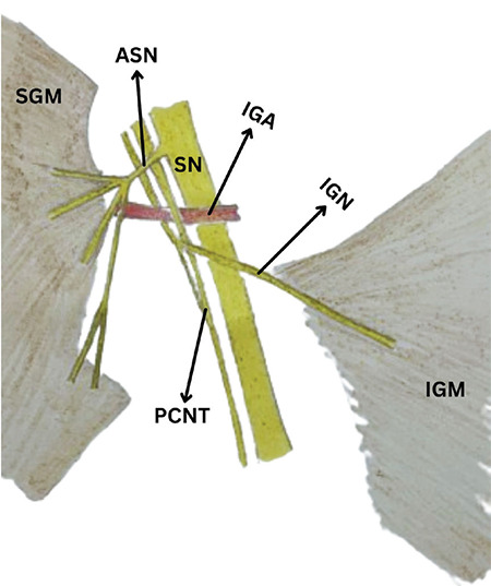 The Dual Innervation of the Gluteus Maximus Associated with Other Anatomical Variations of the Gluteal Region.