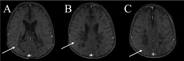 Childhood Cerebral Adrenoleukodystrophy: Case Report and Literature Review Advocating for Newborn Screening.