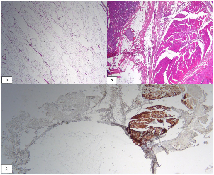 Intramuscular Lipoma of the Sternocleidomastoid Muscle: A Rare Entity Revisited.