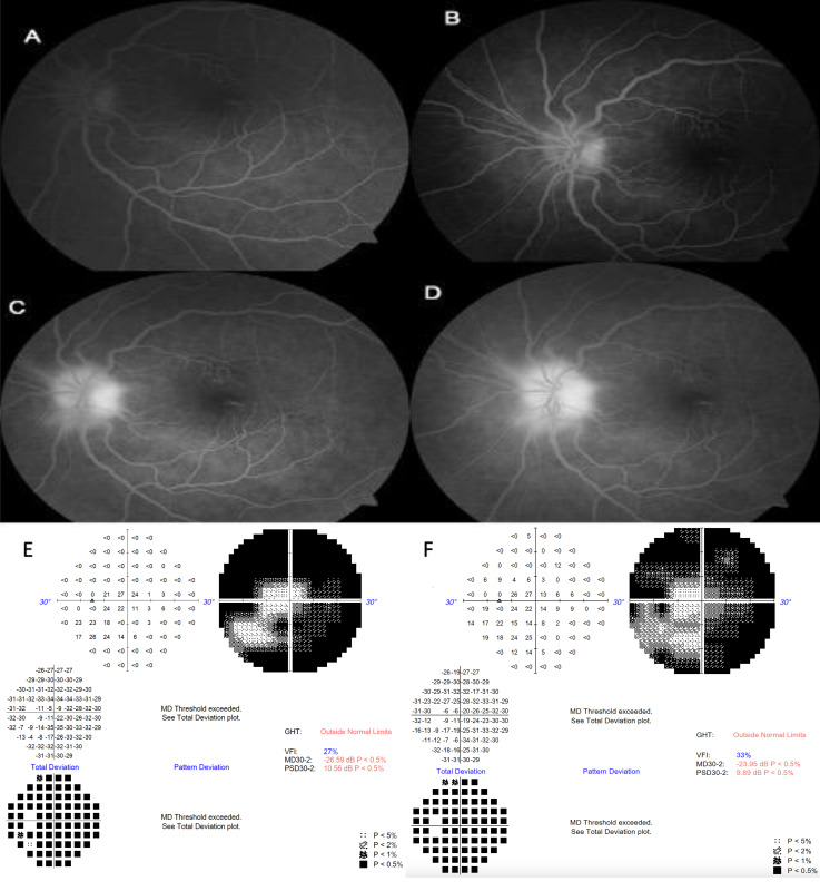 Combined use of intravitreal bevacizumab and oral steroid treatment in three diabetic papillopathy patients: a diagnostic and treatment challenge.