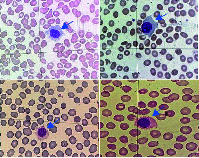 Hairy cell leukemia - etiopathogenesis, diagnosis and modern therapeutic approach.