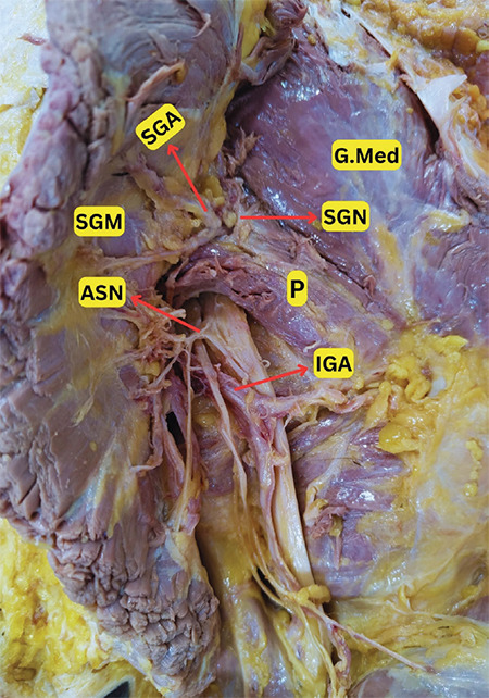 The Dual Innervation of the Gluteus Maximus Associated with Other Anatomical Variations of the Gluteal Region.