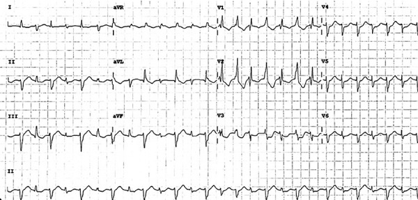 Bidirectional ventricular tachycardia due to digoxin-diuretic interaction in post-cardiac surgery patient: a case report.