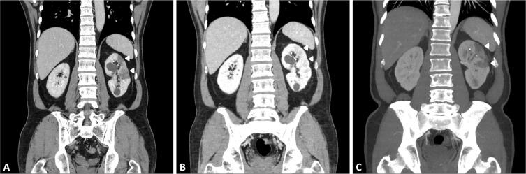 A Case of Recurrent Renal Infarction Following Transient Resolution: Evidence From Serial Computed Tomography.