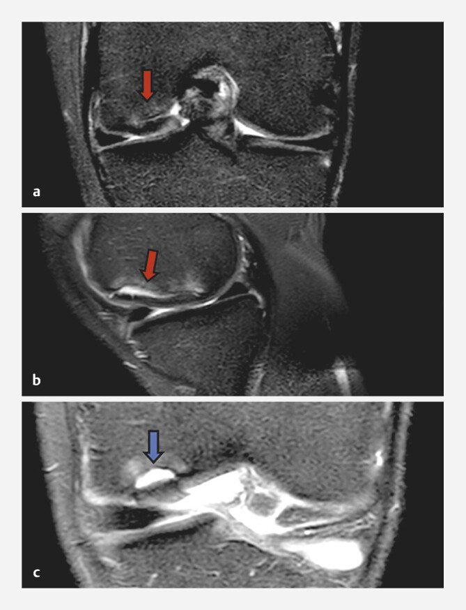 Revision of Failed Osteochondritis dissecans Surgical Treatment: Case Report.