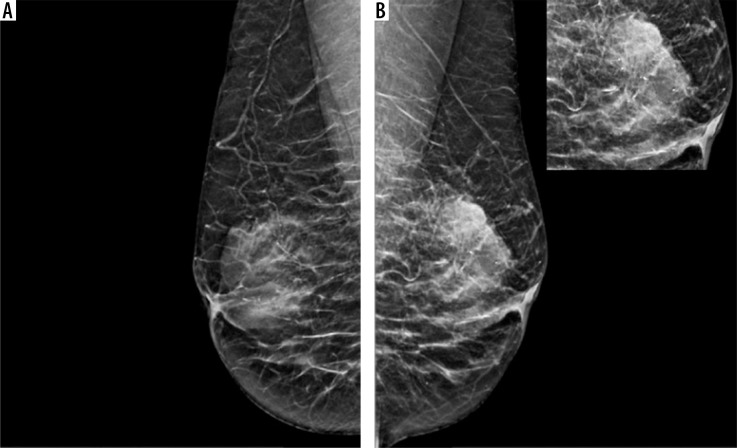 Association of mammographic breast density measurements and hormone receptor status of breast cancer.