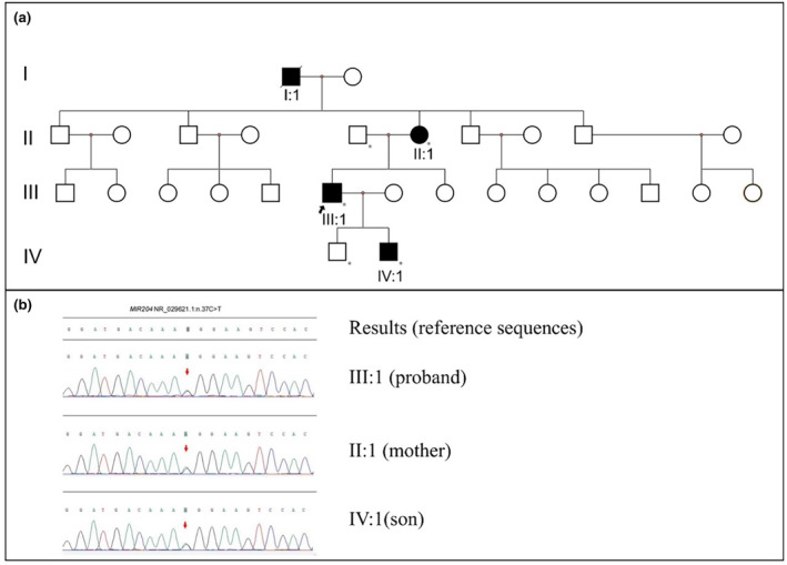 Retinitis pigmentosa with iris coloboma due to miR-204 gene variant in a Chinese family.