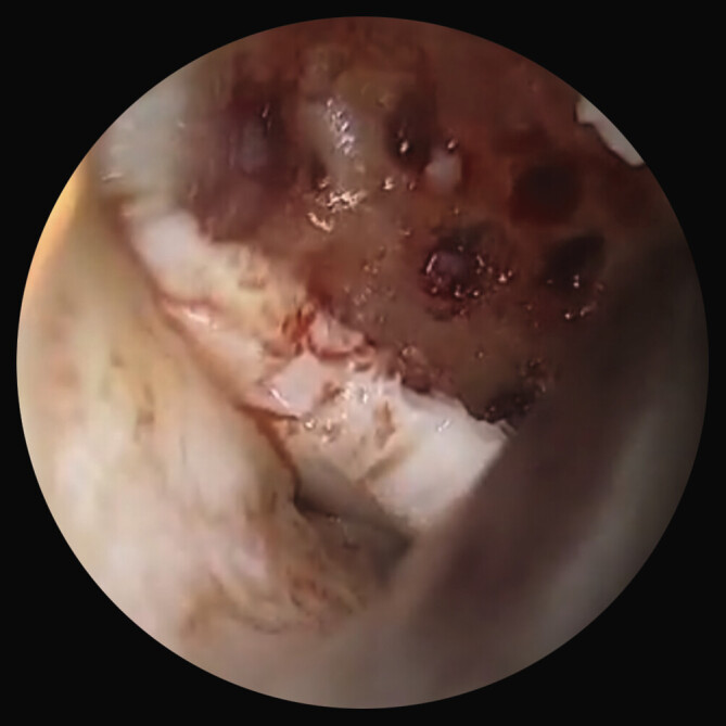 Revision of Failed Osteochondritis dissecans Surgical Treatment: Case Report.
