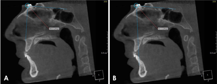 Correlation between cone-beam computed tomographic findings and the apnea-hypopnea index in obstructive sleep apnea patients: A cross-sectional study.