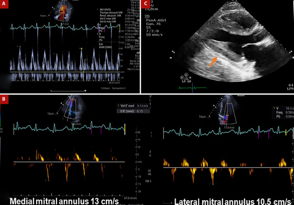 Acute graft rejection mimicking constrictive pericarditis after heart transplantation. A case report.