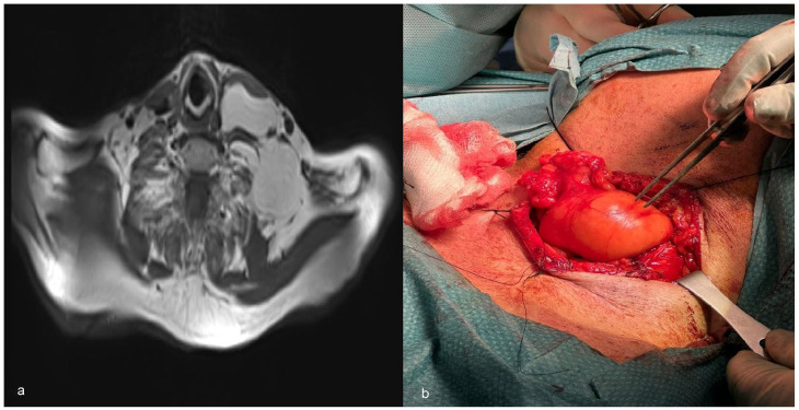 Intramuscular Lipoma of the Sternocleidomastoid Muscle: A Rare Entity Revisited.