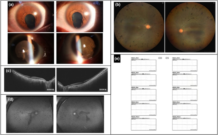 Retinitis pigmentosa with iris coloboma due to miR-204 gene variant in a Chinese family.