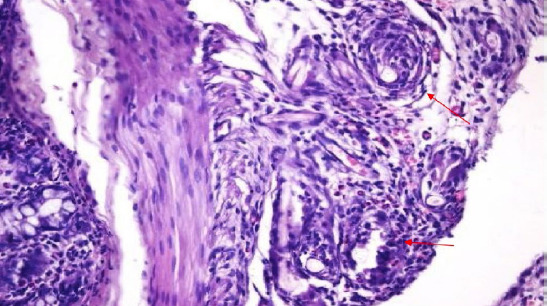 Effects of pioglitazone and metformin on abdominal adhesion formation in an experimental model.