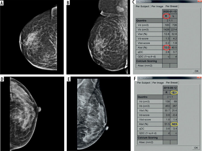 Association of mammographic breast density measurements and hormone receptor status of breast cancer.