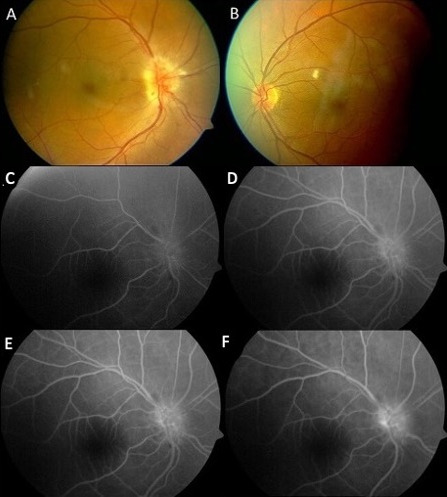 Combined use of intravitreal bevacizumab and oral steroid treatment in three diabetic papillopathy patients: a diagnostic and treatment challenge.