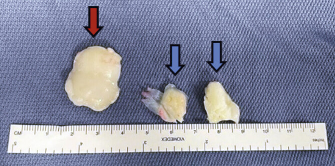 Revision of Failed Osteochondritis dissecans Surgical Treatment: Case Report.
