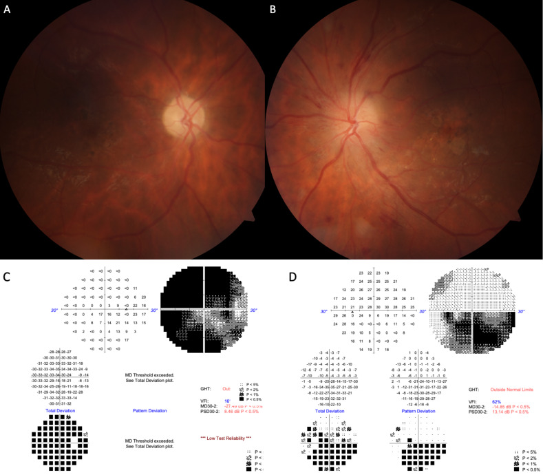 Combined use of intravitreal bevacizumab and oral steroid treatment in three diabetic papillopathy patients: a diagnostic and treatment challenge.