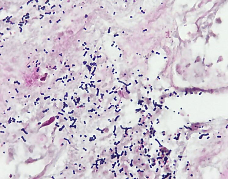 Emerging infection: streptococcal toxic shock-like syndrome caused by group B Streptococcus (GBS), <i>Streptococcus agalactiae</i>.