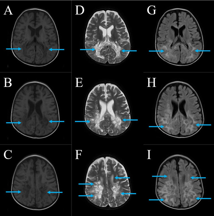 Childhood Cerebral Adrenoleukodystrophy: Case Report and Literature Review Advocating for Newborn Screening.