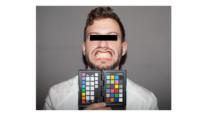 Assessment of Tooth Shade Measurement Precision and Consistency with Digital Photography Calibration System.