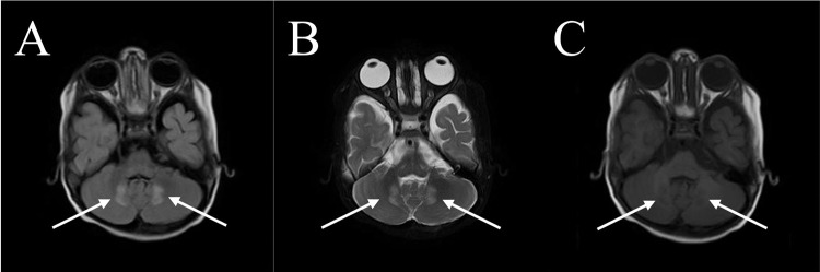 Childhood Cerebral Adrenoleukodystrophy: Case Report and Literature Review Advocating for Newborn Screening.