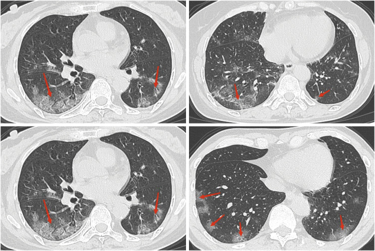 Neoadjuvant Chemotherapy Is Effective in Those Infected With SARS-CoV-2: The Real-World Experience of a Large Chinese Breast Cancer Center.