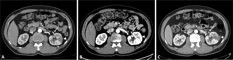 A Case of Recurrent Renal Infarction Following Transient Resolution: Evidence From Serial Computed Tomography.