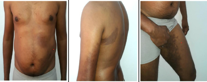 Linear Atrophoderma of Moulin: A Case Report.