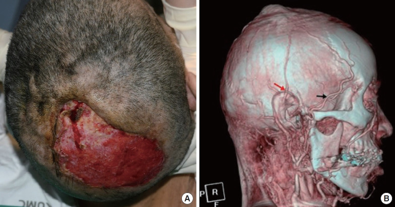 Use of the frontal branch of the superficial temporal artery and the postauricular vein to overcome anatomic variations of superficial temporal vessels in scalp reconstruction with free tissue transfer: a case report.