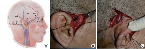 Use of the frontal branch of the superficial temporal artery and the postauricular vein to overcome anatomic variations of superficial temporal vessels in scalp reconstruction with free tissue transfer: a case report.