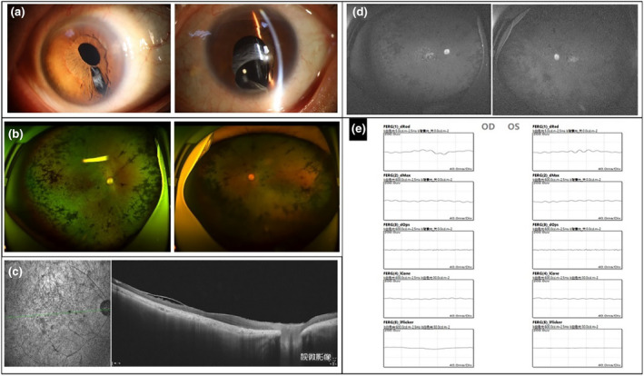 Retinitis pigmentosa with iris coloboma due to miR-204 gene variant in a Chinese family.
