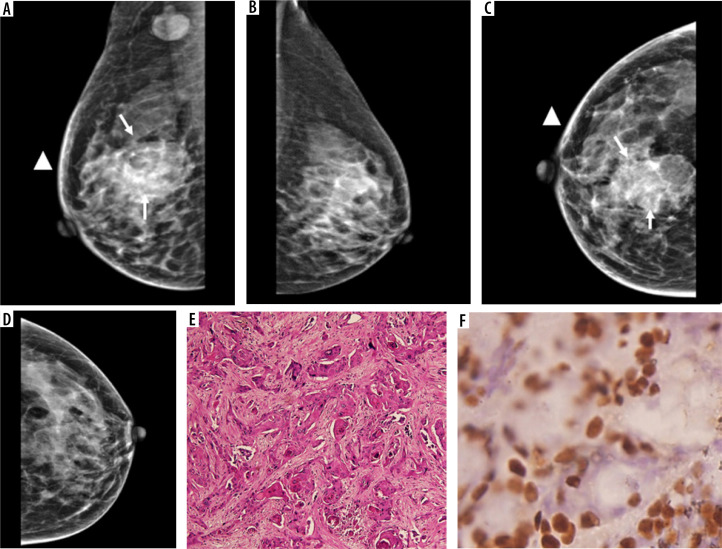 Association of mammographic breast density measurements and hormone receptor status of breast cancer.