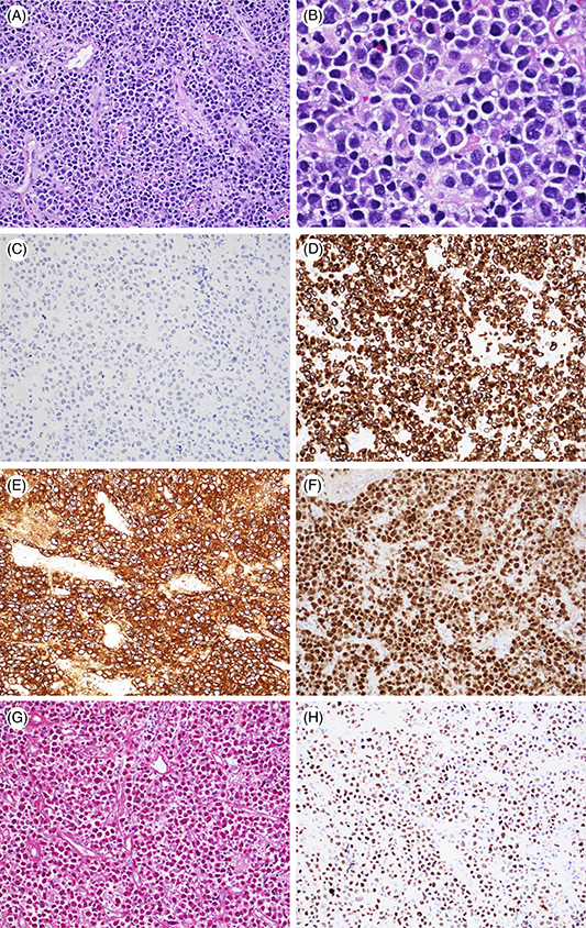 Extracavitary primary effusion lymphoma presenting as a solitary brain mass.