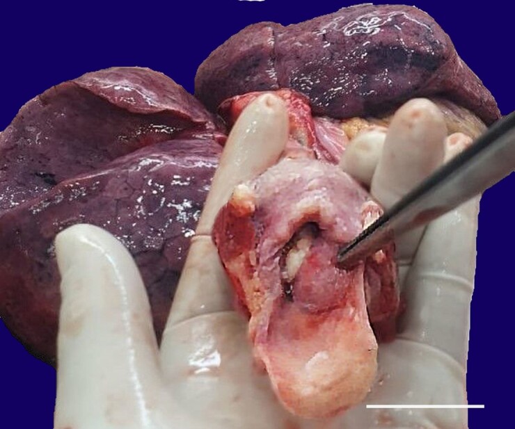 Fatal asphyxia due to large laryngeal granuloma.