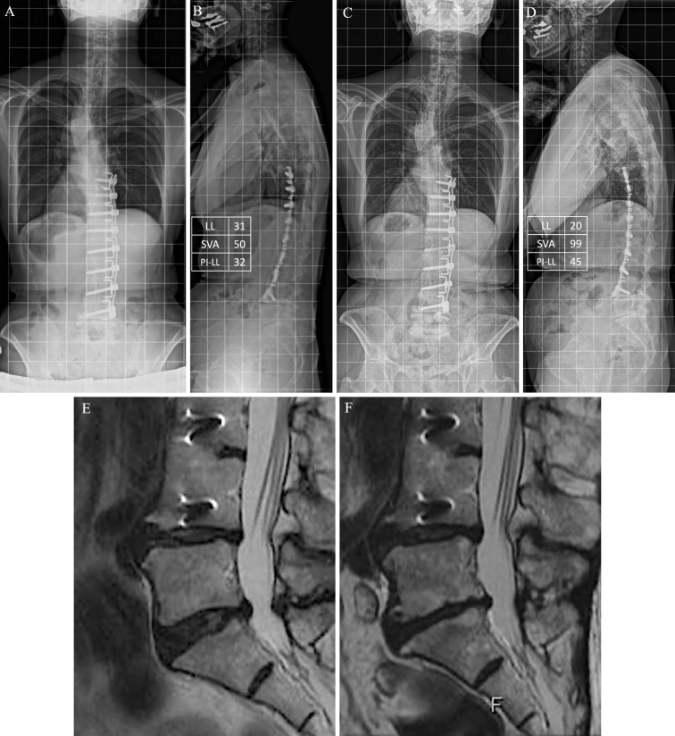 Intervertebral Disc Degeneration in Long-Term Postoperative Patients with Adolescent Idiopathic Scoliosis: MRI Evaluation 34-51 Years after Surgery and its Changes during Middle and Older Age for an Average of 6.9 Years.