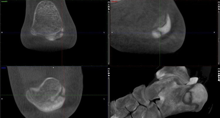 Combined Electromagnetic and Electrohydraulic Focused ESWT and EMTT for Delayed Calcaneal Union in an Adolescent Parkour Athlete - A Case Report.