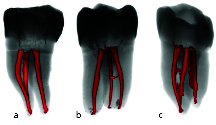 Quality of Root Canal Filling in Curved Canals Utilizing Warm Vertical Compaction and Two Different Single Cone Techniques: A Three-Dimensional Micro-Computed Tomography Study.