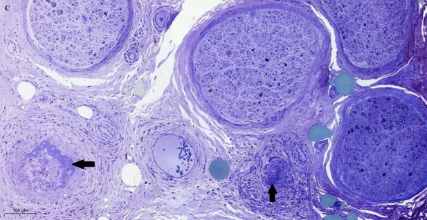A great simulator in clinical practice: mononeuritis multiplex in HIV infection.