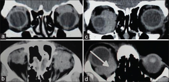 Radiopathological Correlation in Orbital Lesions.